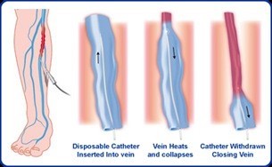Varicose Veins Surgery Cost