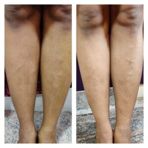 varicose vein treatment at The Venkat Center