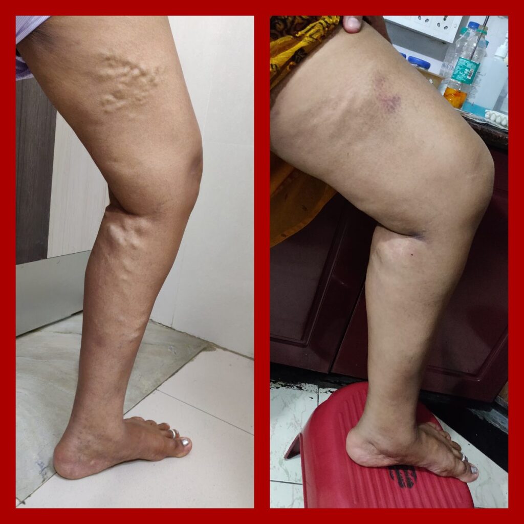 Varicose Veins Surgery Cost