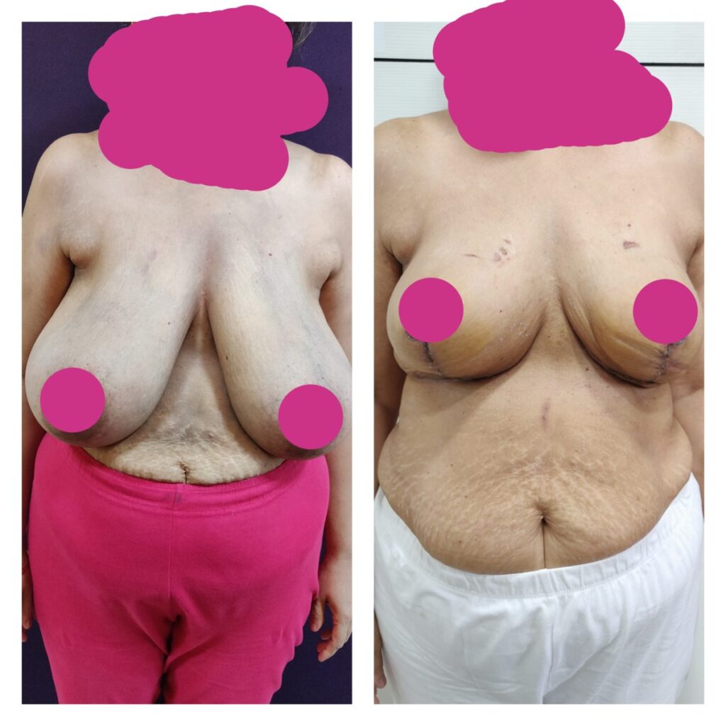 very large breast reduction at venkat center bangalore (1 kg per side)