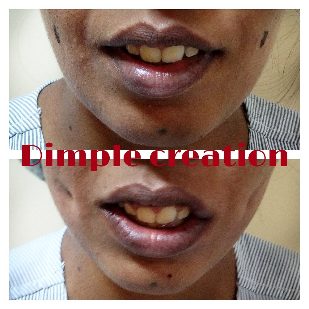Dimple Creation Cost In Bangalore Venkat Center For Skin