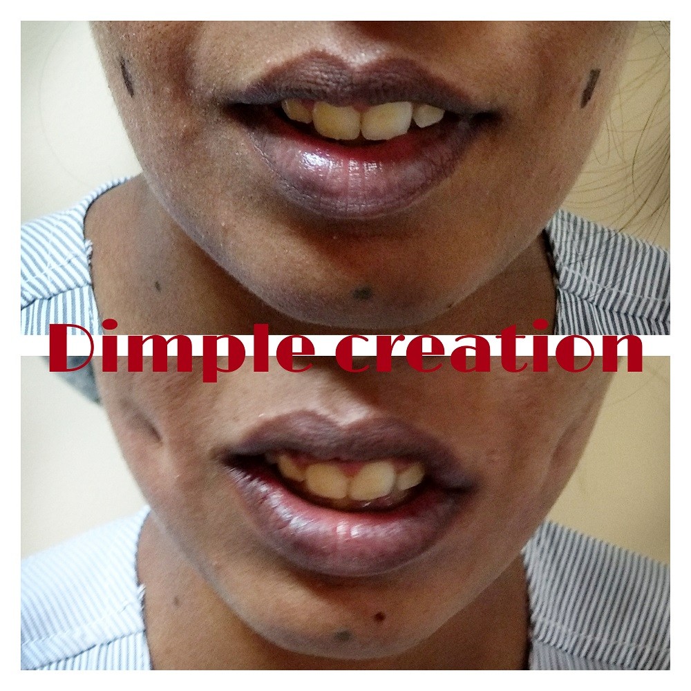 dimple surgery cost in bangalore