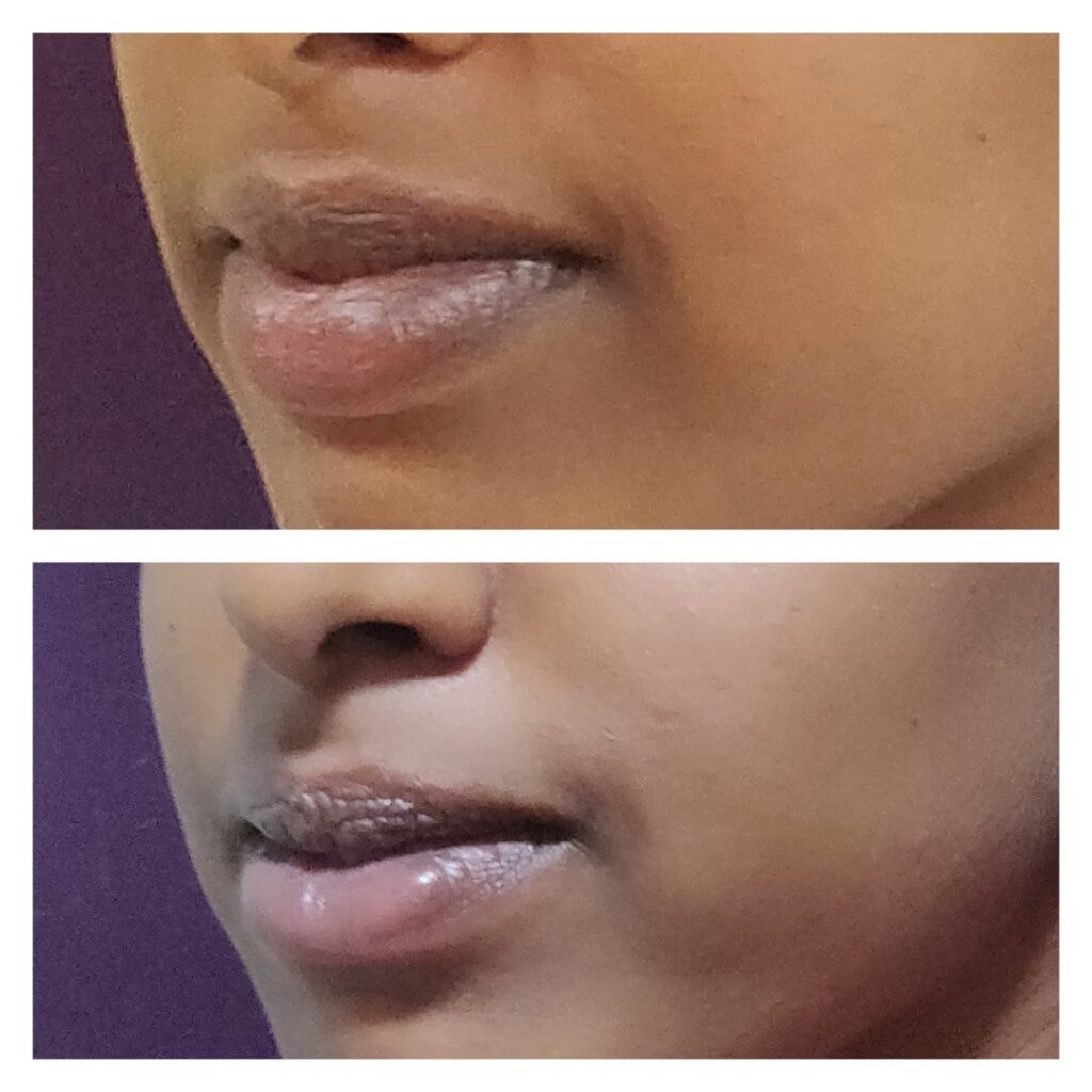 Lip Reduction Surgery Cost 7