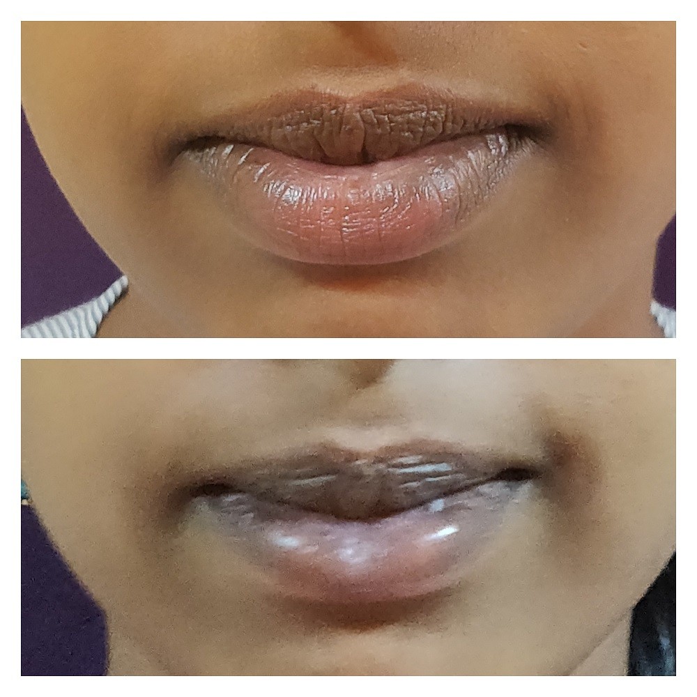 Lip Reduction Surgery Cost 2