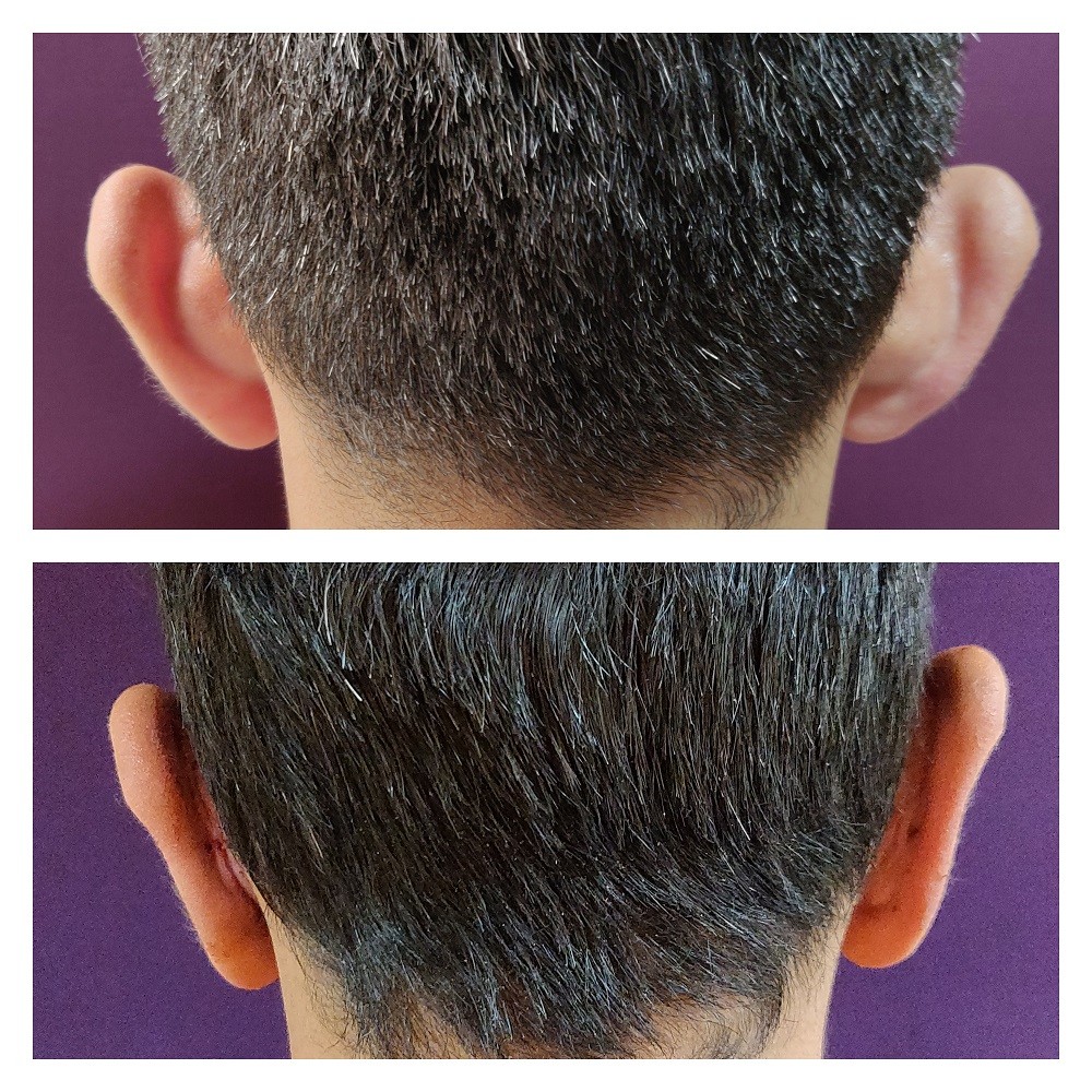 Prominent ear correction at Venkat Center, Bangalore