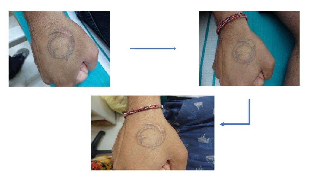 laser Tattoo Removal Patients at The Venkat Center