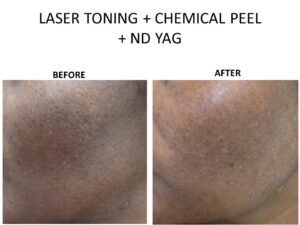 Best pigmentation treatment in Bangalore