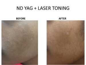 Best pigmentation treatment in Bangalore