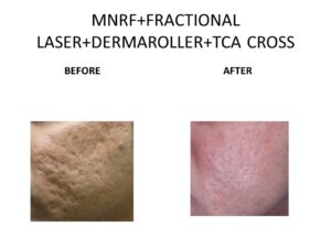 Laser Scar Removal at Venkat Center, Bangalore