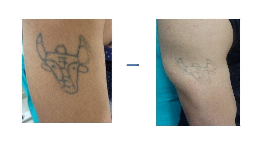 Tattoo Removal Patients at The Venkat Center