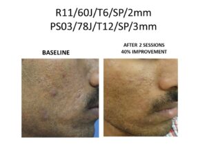 Laser Scar Removal at Venkat Center, Bangalore