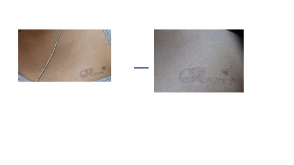 Tattoo Removal Patients at The Venkat Center