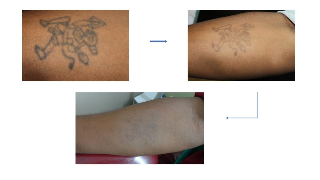 Best tattoo removal in Bangalore