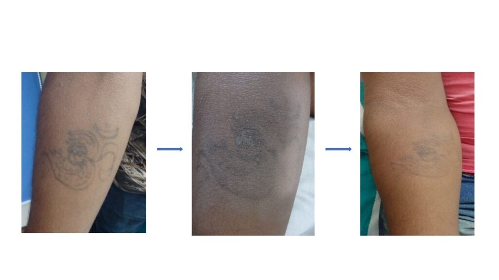 Tattoo Removal Patients at The Venkat Center