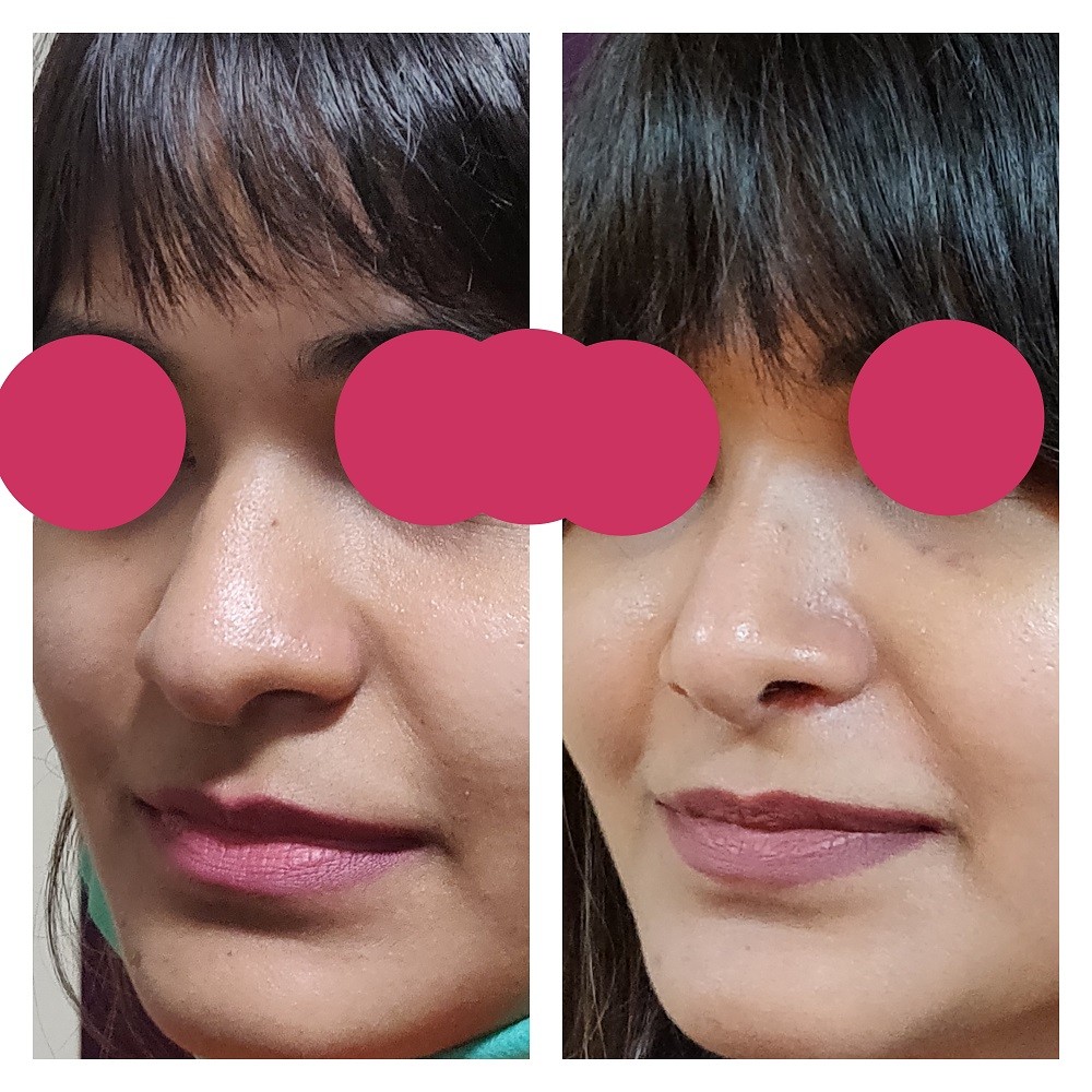 Nose Surgery Cost, Bangalore. Leading Nose Reshaping Rhinoplasty Surgeon In India