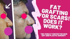 Fat grafting for scars? - Venkat Center, Bangalore