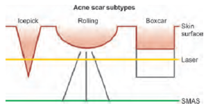 Acne scar subtypes