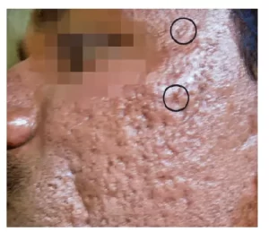 Acne scar treatment at Venkat Center, Bangalore