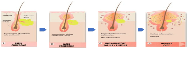 Acne scarring