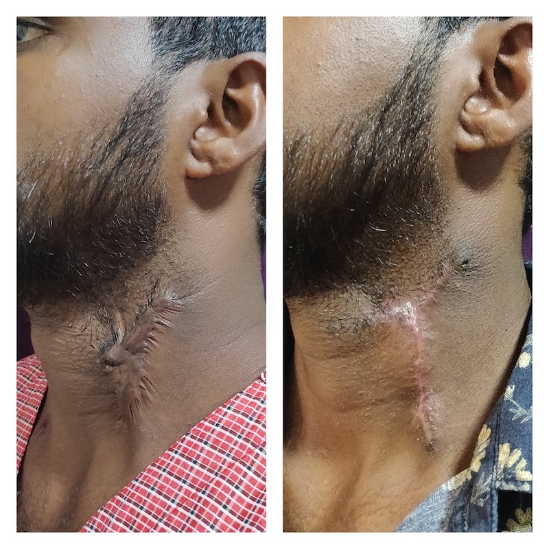 Screen Scars Treatment