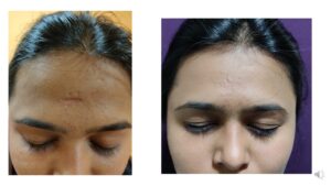 Scar Revision at the Venkat Center, Bangalore