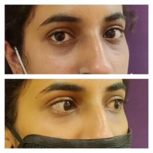 Dermal Filler Treatment 26 Under eye filler at Venkat Center, Bangalore