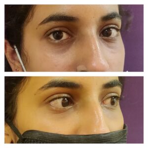 Under eye filler at Venkat Center, Bangalore