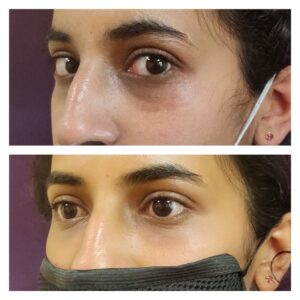 Under eye filler at Venkat Center, Bangalore