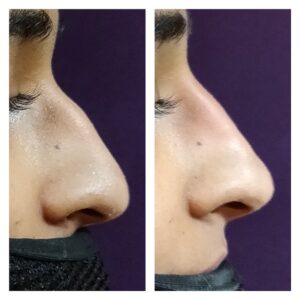 Non Surgical Rhinoplasty