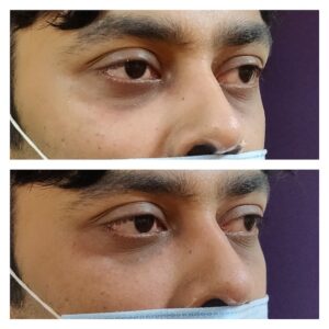 Dermal Filler Treatment 27 Under eye filler at Venkat Center, Bangalore