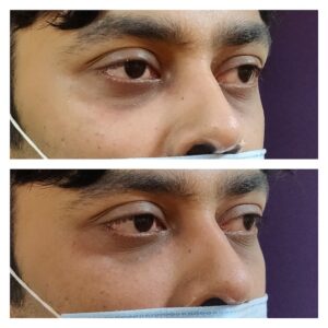 Under eye filler at Venkat Center, Bangalore