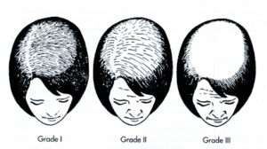 Classification of hairfall in women