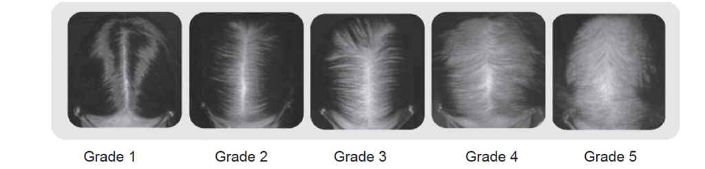 Hair Transplantation in Women