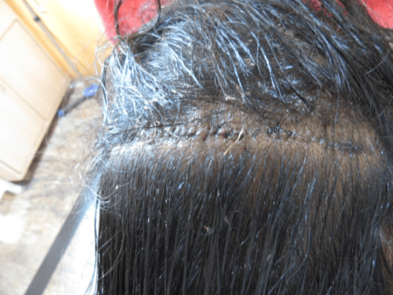 Hair Transplant in women - DONOR area FUT strip and stich