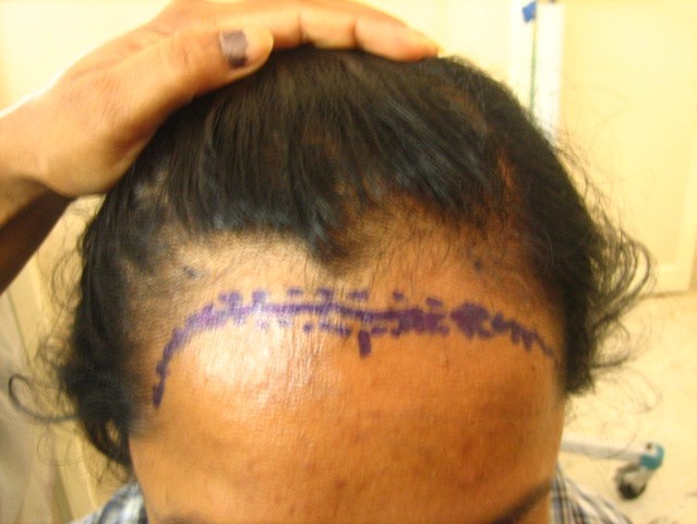 Hair Transplant in women at Venkat Center, Bangalore