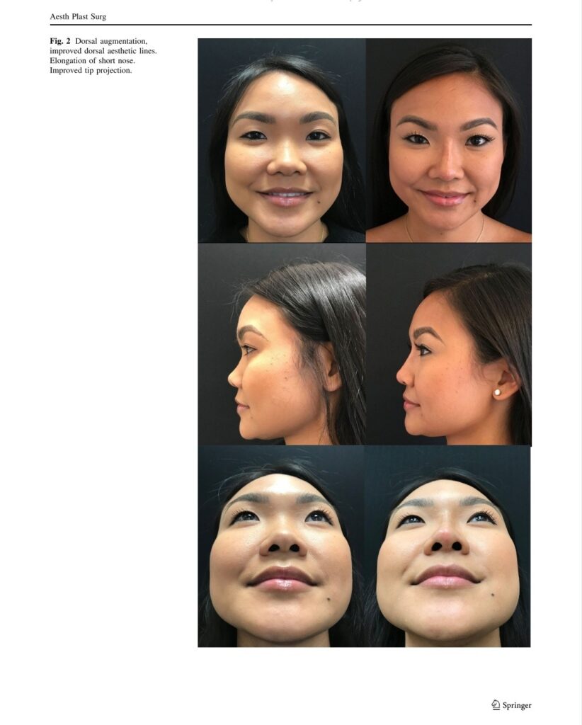 Dr. Aniketh Venkataram's article on Non-surgical Rhinoplasty