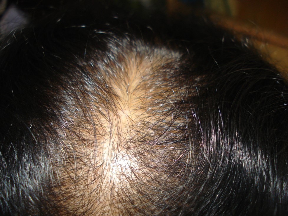 Results of Hair Transplant in women at Venkat Center, Bangalore