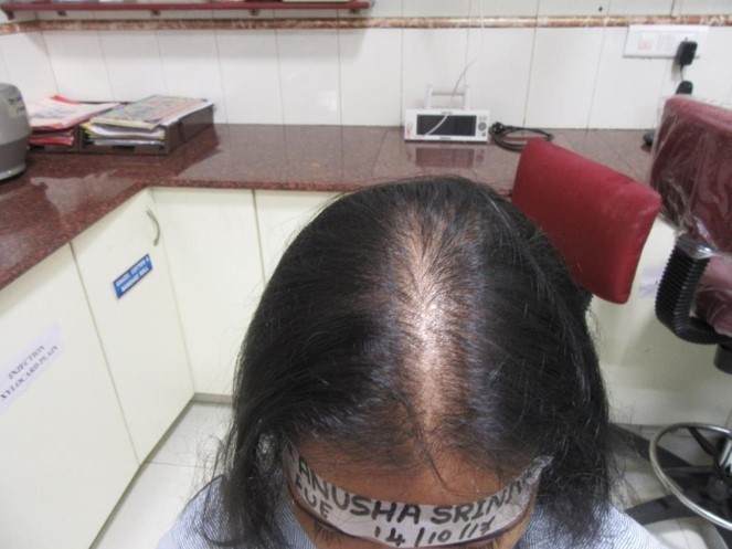 (Before) Hair Transplant in women at Venkat Center, Bangalore