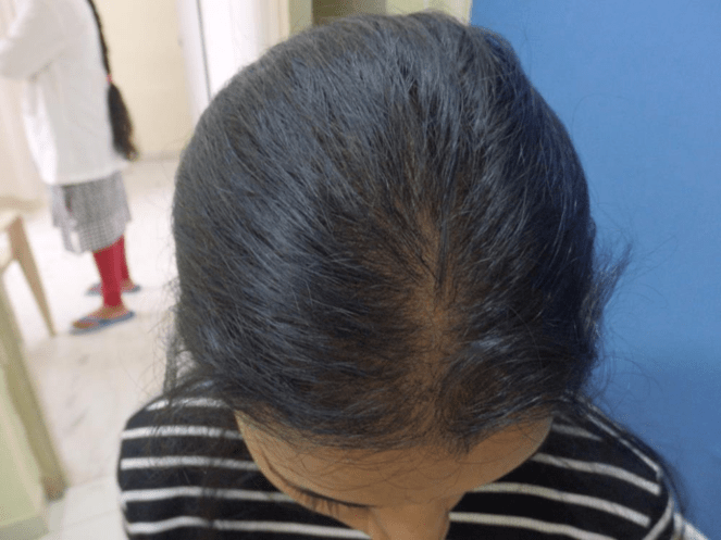 (After) Hair Transplant in women at Venkat Center, Bangalore