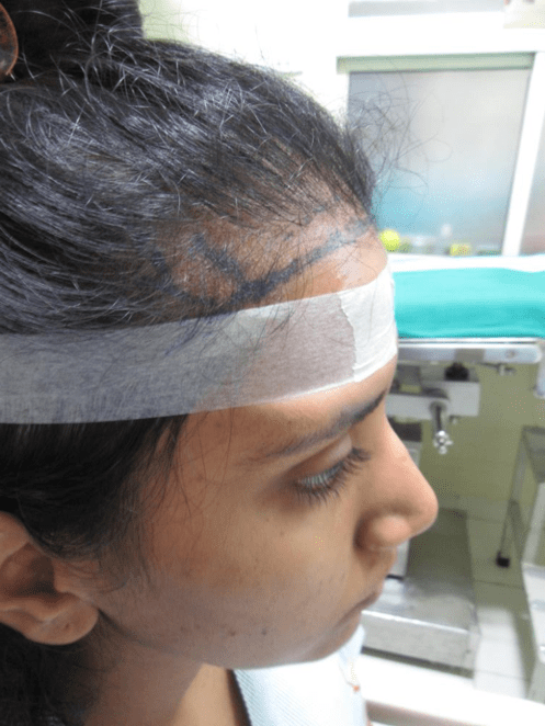 (Before) Hair Transplant in women at Venkat Center, Bangalore