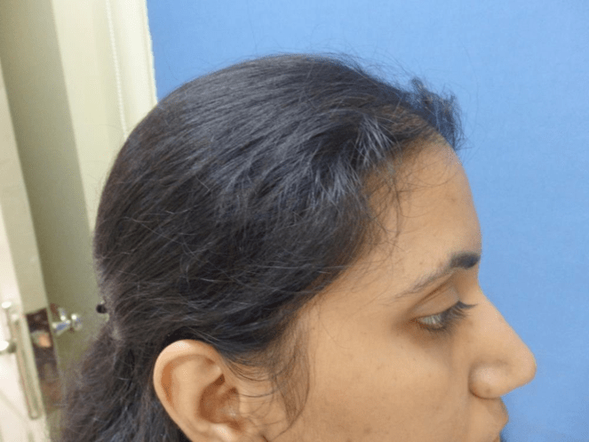 (After) Hair Transplant in women at Venkat Center, Bangalore