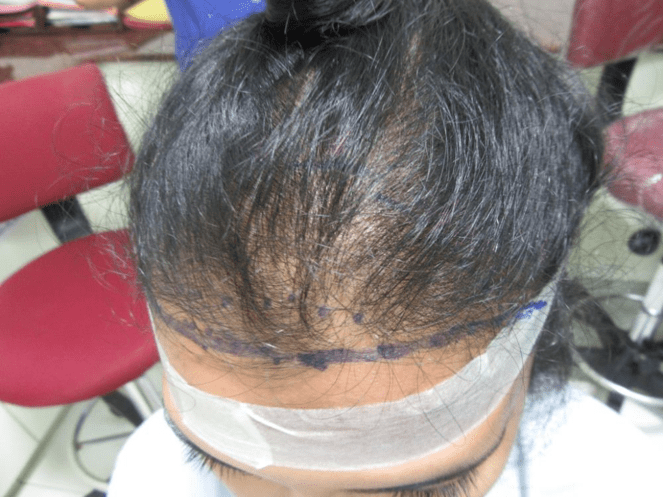 (Before) Hair Transplant in women at Venkat Center, Bangalore