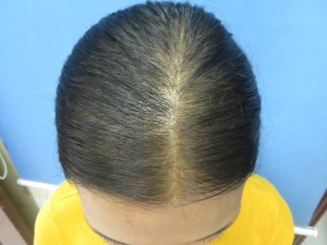 (After) Hair Transplant in women at Venkat Center, Bangalore