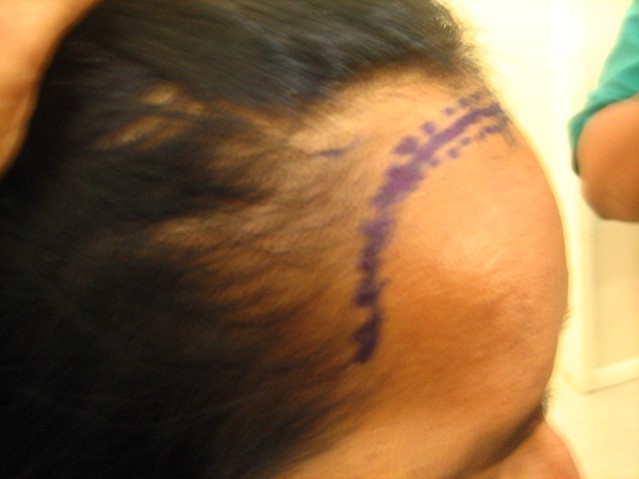 Hair Transplant in women at Venkat Center, Bangalore