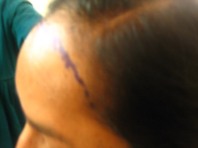 Hair Transplant in women at Venkat Center, Bangalore