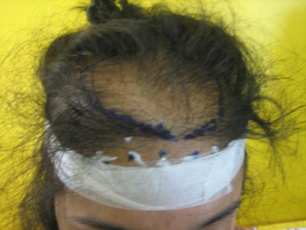 (Grafts) Hair Transplant in women at Venkat Center, Bangalore