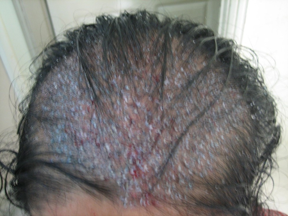 Grafts) Hair Transplant in women at Venkat Center, Bangalore