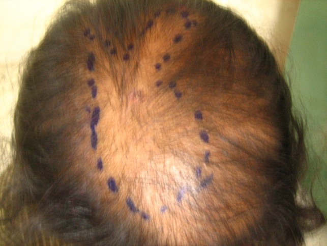 Results of Hair Transplant in women at Venkat Center, Bangalore