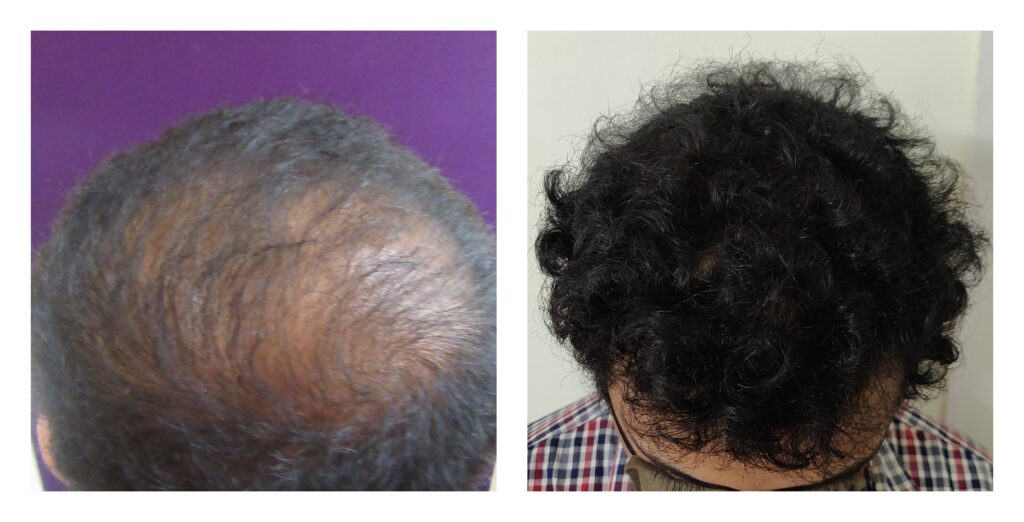 crown hair transplant