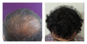 Vertex hair transplant at Venkat Center, Bangalore